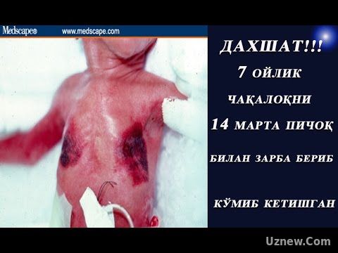 Пичоклаб Кетилган Чакалок,Тирик Колган..